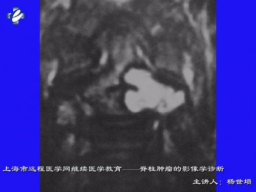 脊柱肿瘤的影像学诊断(2)-文档资料