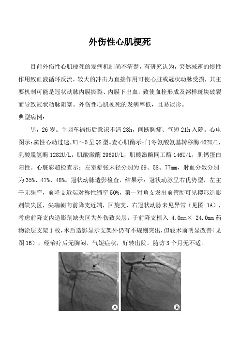 外伤性心肌梗死