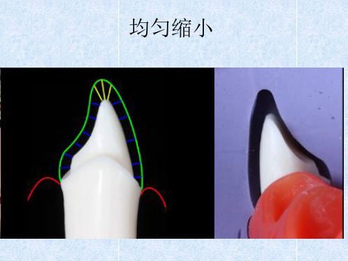 前牙牙体预备
