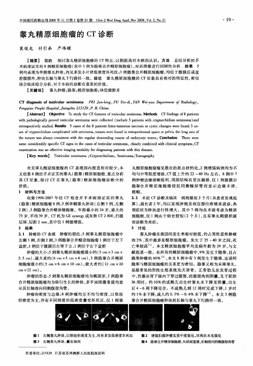 睾丸精原细胞瘤的CT诊断