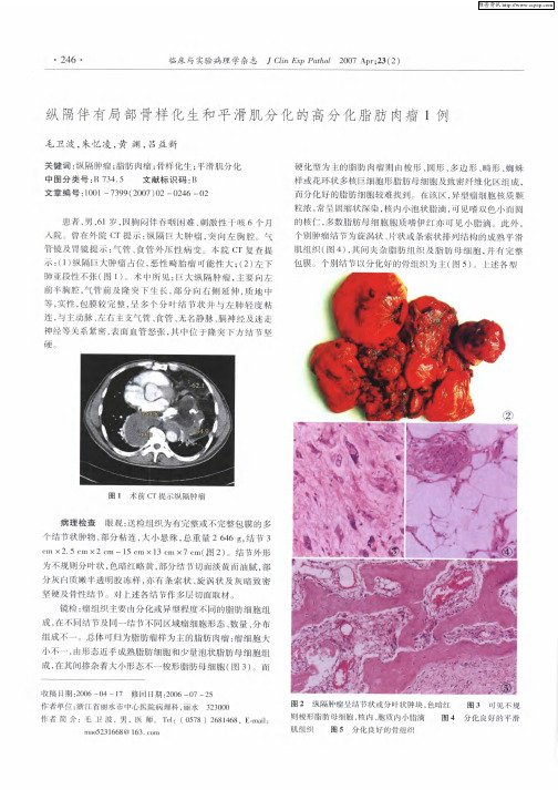 纵隔伴有局部骨样化生和平滑肌分化的高分化脂肪肉瘤1例