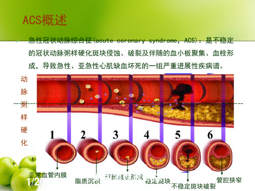 新版急性冠脉综合征的护理培训课件
