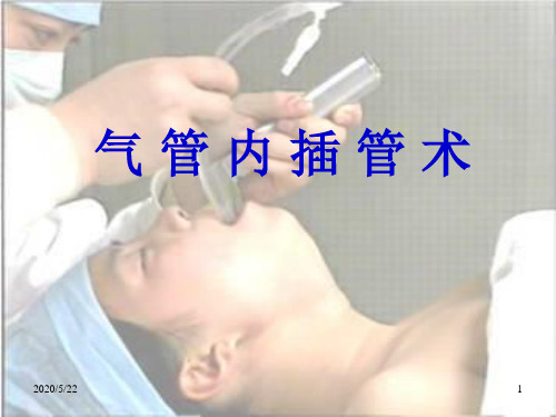 气管插管术