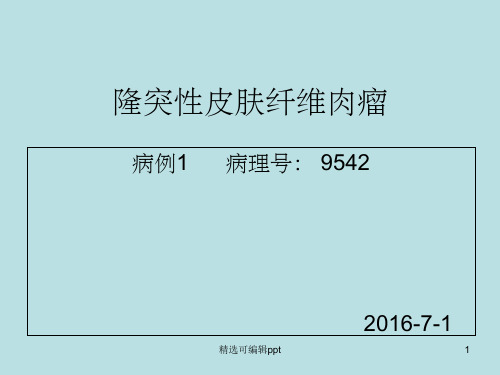 隆突性皮纤维肉瘤
