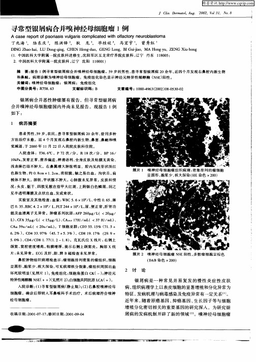 寻常型银屑病合并嗅神经母细胞瘤1例