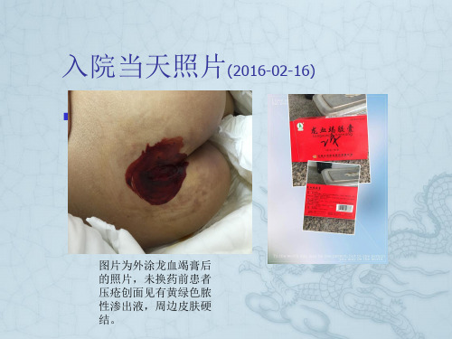 压疮个案分享