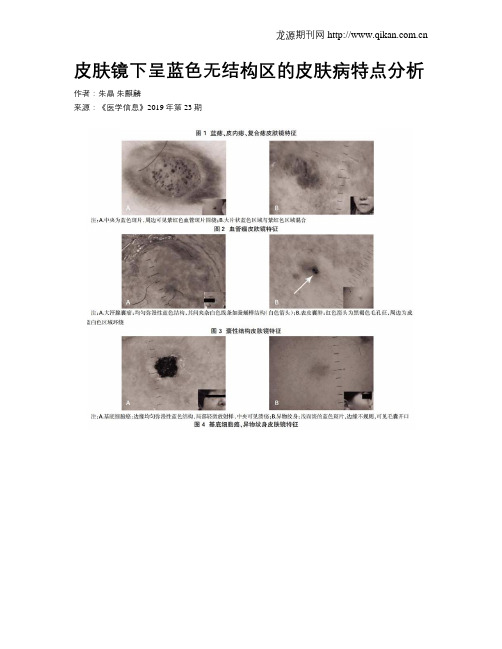 皮肤镜下呈蓝色无结构区的皮肤病特点分析