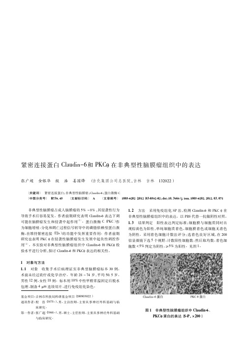 紧密连接蛋白Claudin-6和PKCθ在非典型性脑膜瘤组织中的表达
