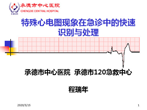 特殊心电图现象在急诊中的快速识别与处理