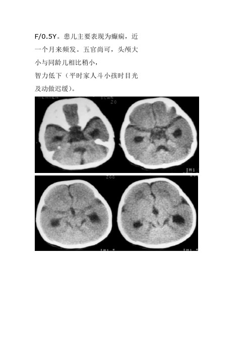畸形：无、巨脑回畸形浅论