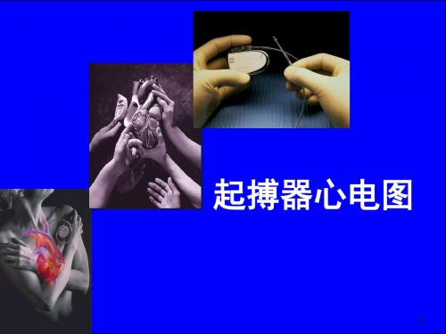 起搏器心电图的解读PPT精选课件