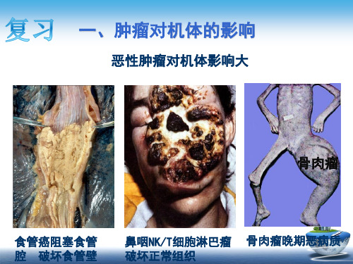 配套课件 病理学 第五章  肿瘤(4 病因学和发病学 重要概念)