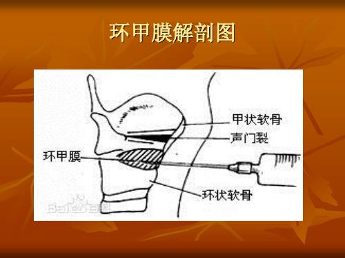 环甲膜穿刺
