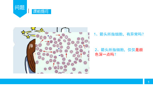 遗传性球形红细胞增多症