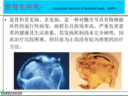 苏州大学附属瑞华医院刘得俊股骨头坏死外科治疗