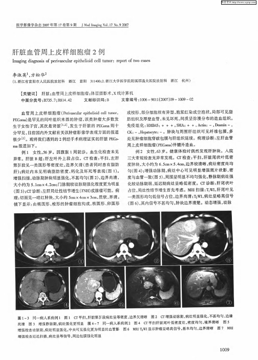 肝脏血管周上皮样细胞瘤2例