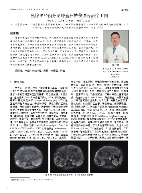 胰腺神经内分泌肿瘤肝转移综合治疗1_例