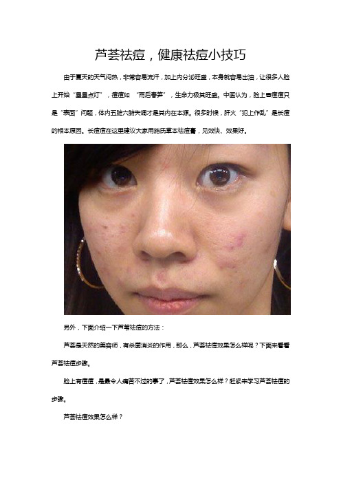 芦荟祛痘,健康祛痘小技巧