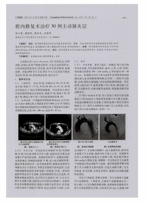 腔内修复术治疗30例主动脉夹层