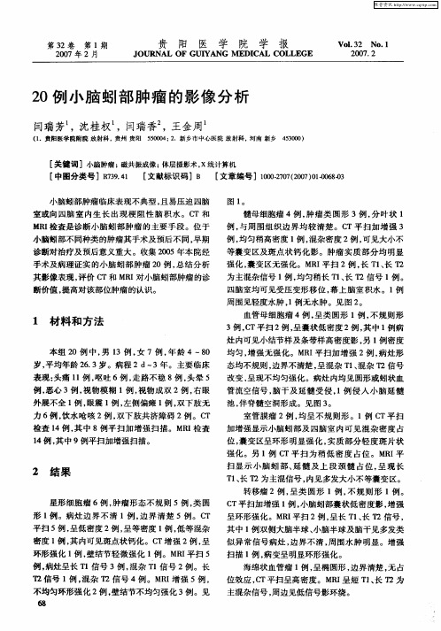 20例小脑蚓部肿瘤的影像分析