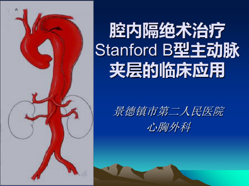 腔内隔绝术治疗Stanford