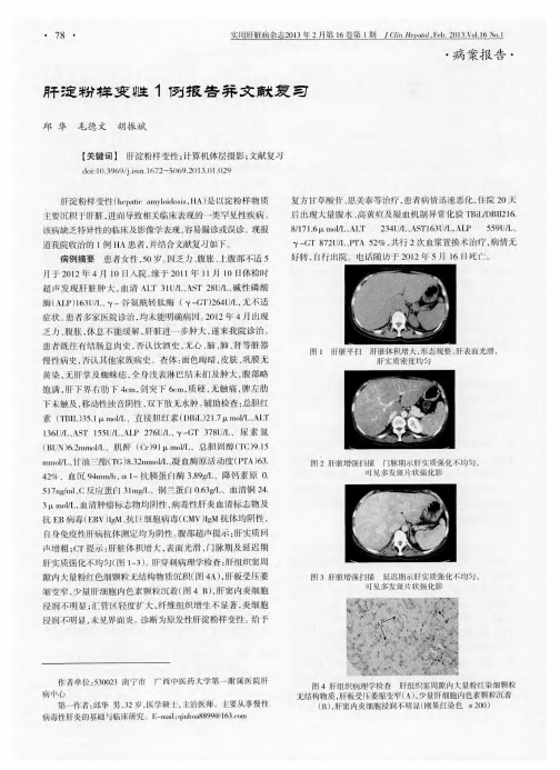 肝淀粉样变性1例报告并文献复习