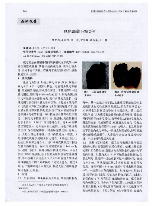 骶尾部藏毛窦2例