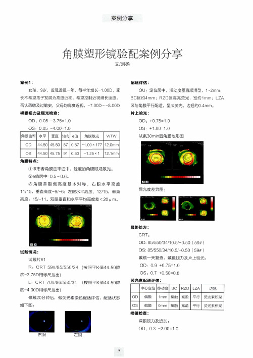 角膜塑形镜验配案例分享