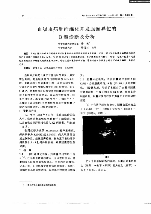 血吸虫病肝纤维化并发胆囊异位的B超诊断及分析