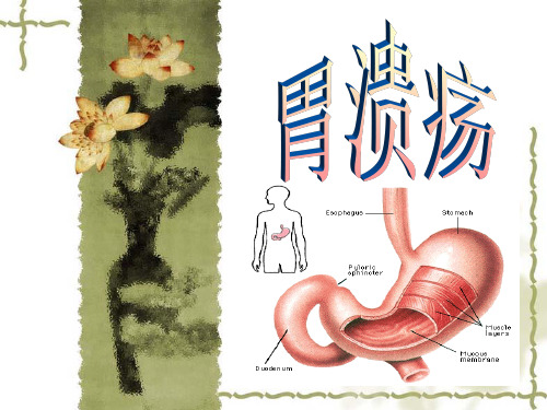 胃溃疡 PPT课件