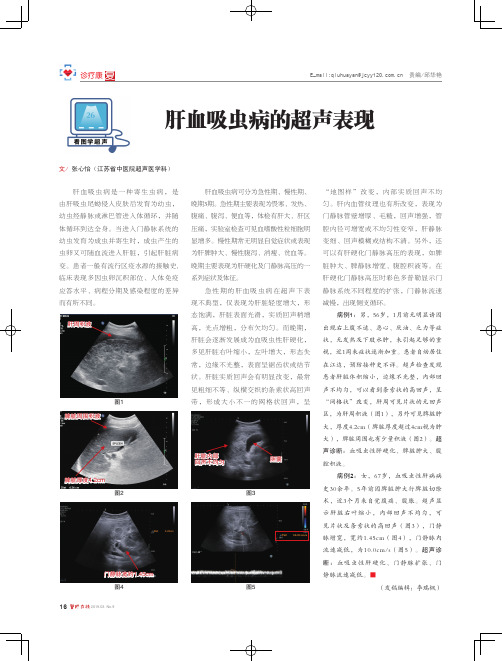 肝血吸虫病的超声表现