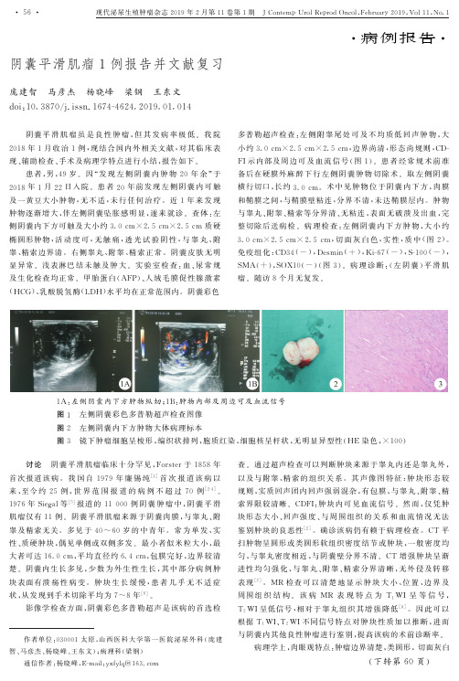 阴囊平滑肌瘤1例报告并文献复习