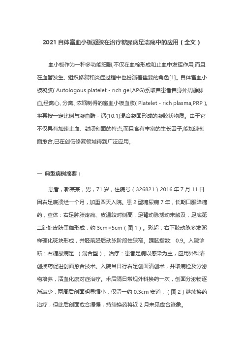 2021自体富血小板凝胶在治疗糖尿病足溃疡中的应用(全文)