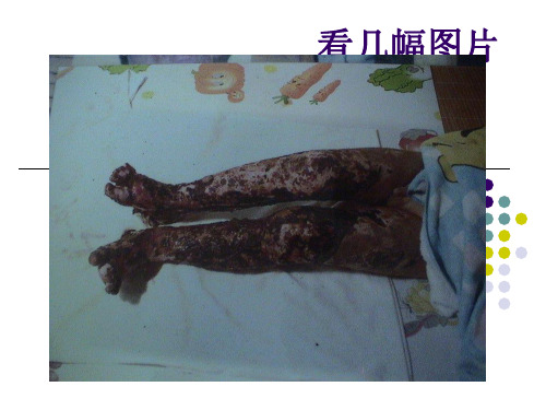 烧烫伤的急救PPT课件