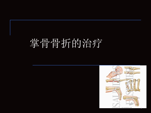 掌骨骨折的治疗精品PPT课件
