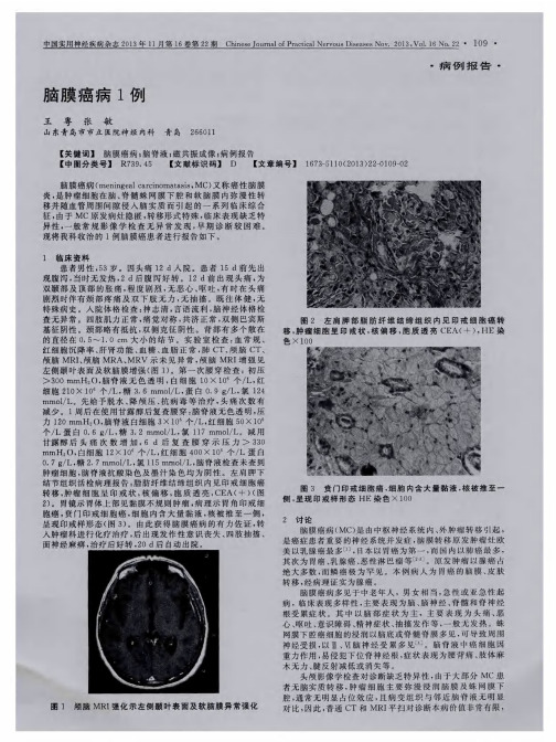 脑膜癌病1例