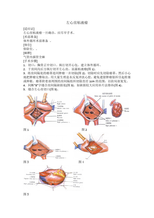 左心房粘液瘤