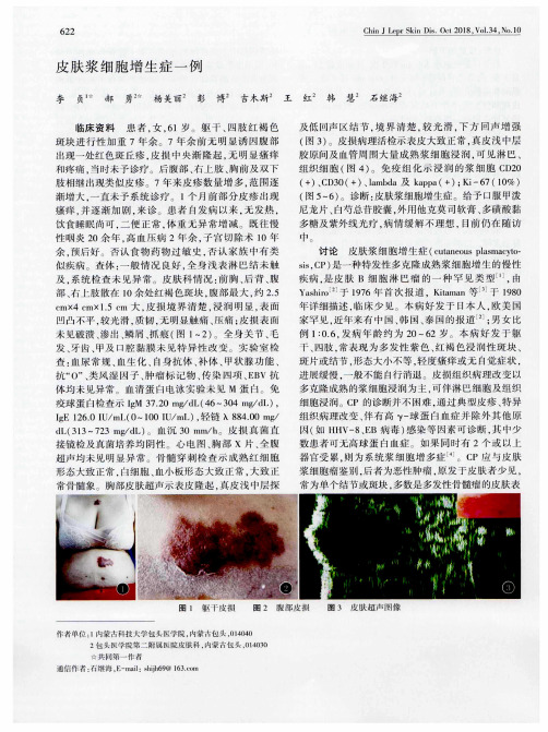 皮肤浆细胞增生症一例