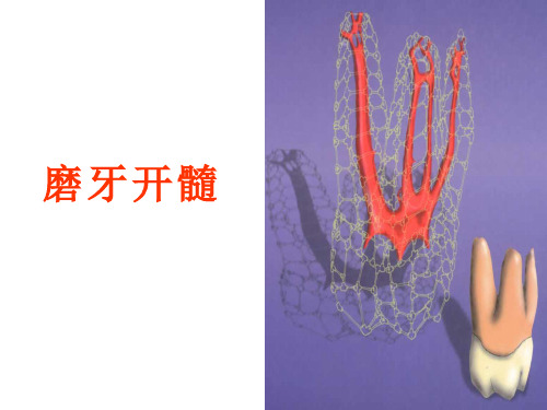 磨牙开髓课件