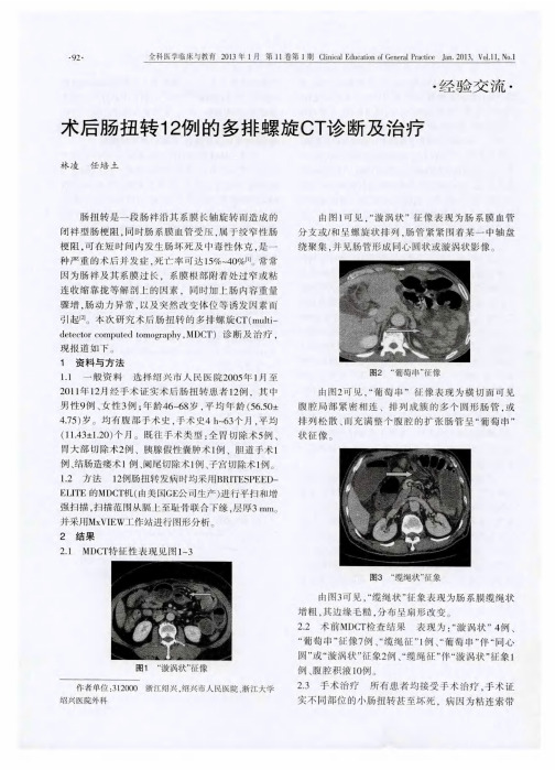 术后肠扭转12例的多排螺旋CT诊断及治疗