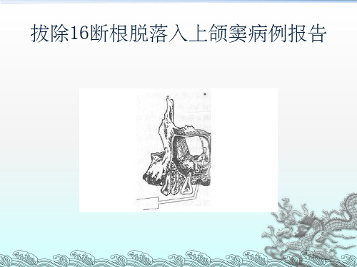 拔除16断根脱落入上颌窦病例