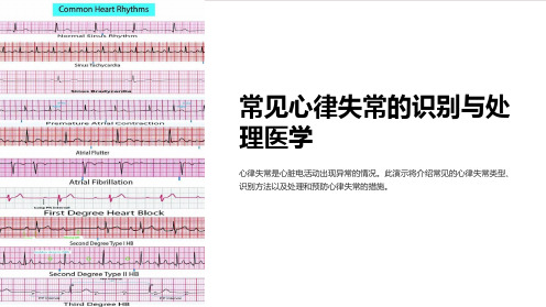 常见心律失常的识别与处理医学