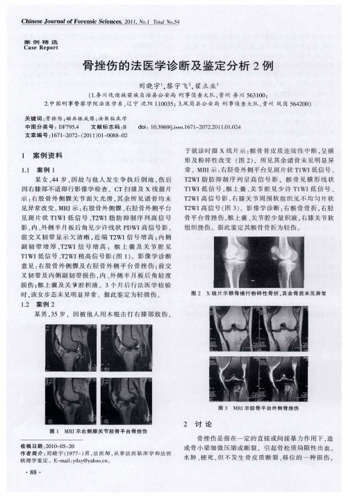 骨挫伤的法医学诊断及鉴定分析2例