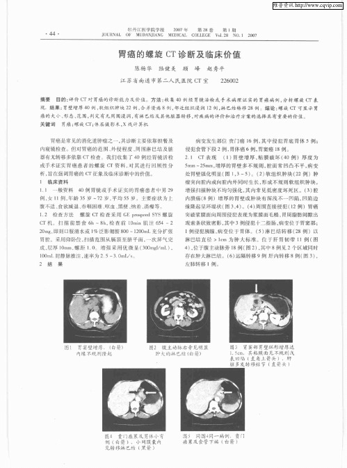 胃癌的螺旋CT诊断及临床价值