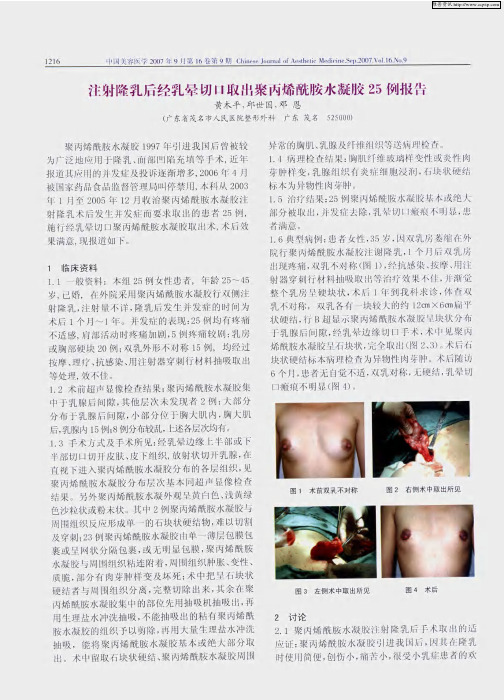 注射隆乳后经乳晕切口取出聚丙烯酰胺水凝胶25例报告