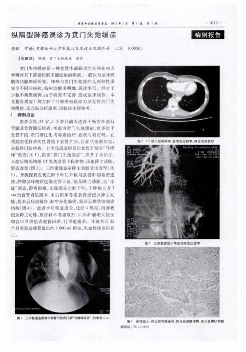 纵隔型肺癌误诊为贲门失弛缓症