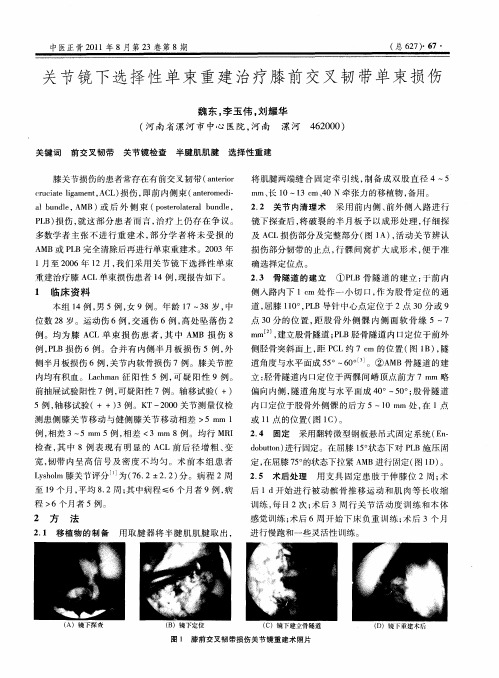 关节镜下选择性单束重建治疗膝前交叉韧带单束损伤
