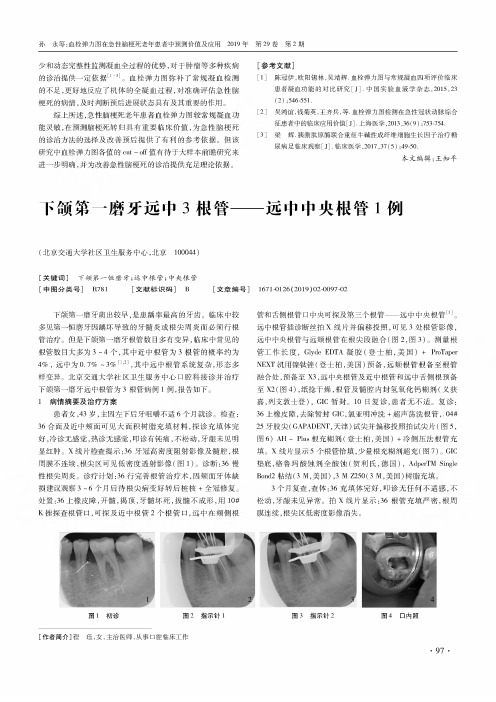 下颌第一磨牙远中3根管——远中中央根管1例