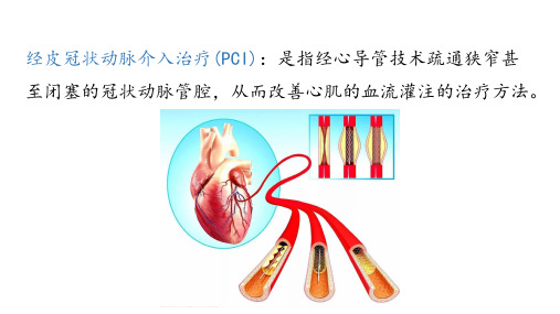 经皮冠状动脉介入治疗(PCI)适应症和禁忌症