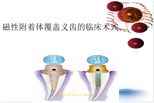 磁性附着体覆盖义齿临床术式